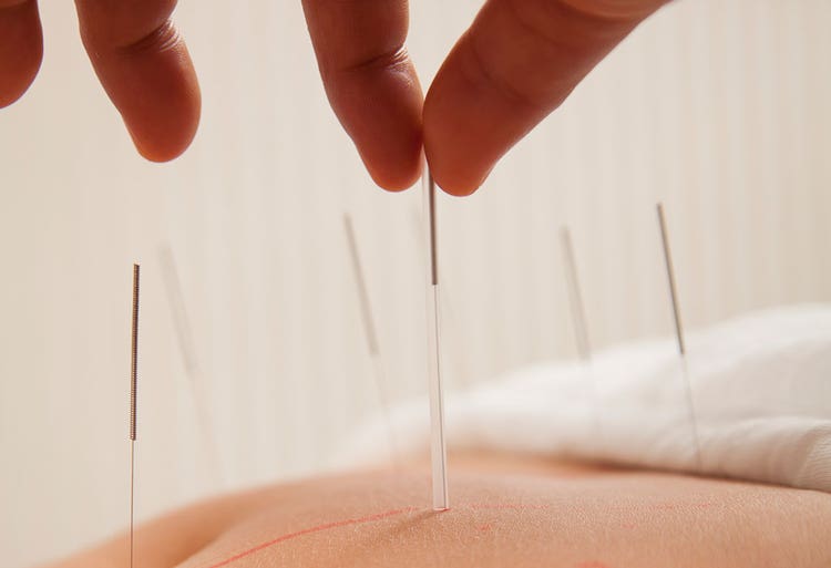 acupuncture